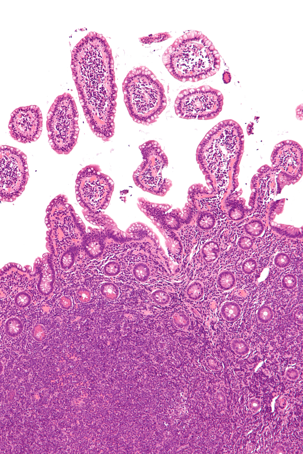 Micrografía de un linfoma de células del manto (zona inferior de la imagen) Autor/a: Nephron Fuente: Wikipedia