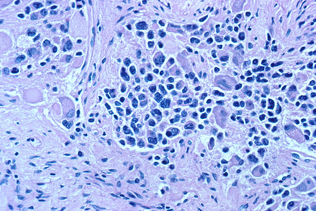 Células de ganglio nervioso con neuroblastoma Autor/a: (cargado por Filip em) Fuente: Wikipedia