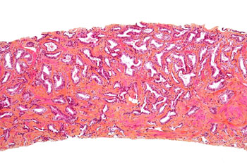Micrografía relativa a un cáncer de próstata Autor/a de la imagen: Nephron  Fuente: Wikipedia