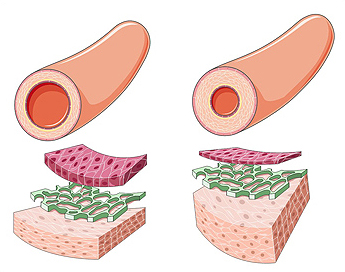 Remodelado arterial en hipertensión arterial Autor/a de la imagen: hugovillarroelabrego Fuente: Wikipedia