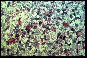 ‘Mycobacterium leprae’, agente causante de la lepra M. leprae se tiñe de rojo cuando se utiliza la tinción de Ziehl-Neelsen Autor/a-Fuente primaria de la imagen: US Department of Health and Human Services Fuente: Wikipedia / Viquipèdia / Balthazaar