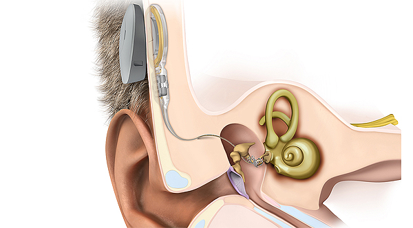 Ilustración del nuevo implante avanzado de oído medio  Fuente: Clínica Universidad de Navarra