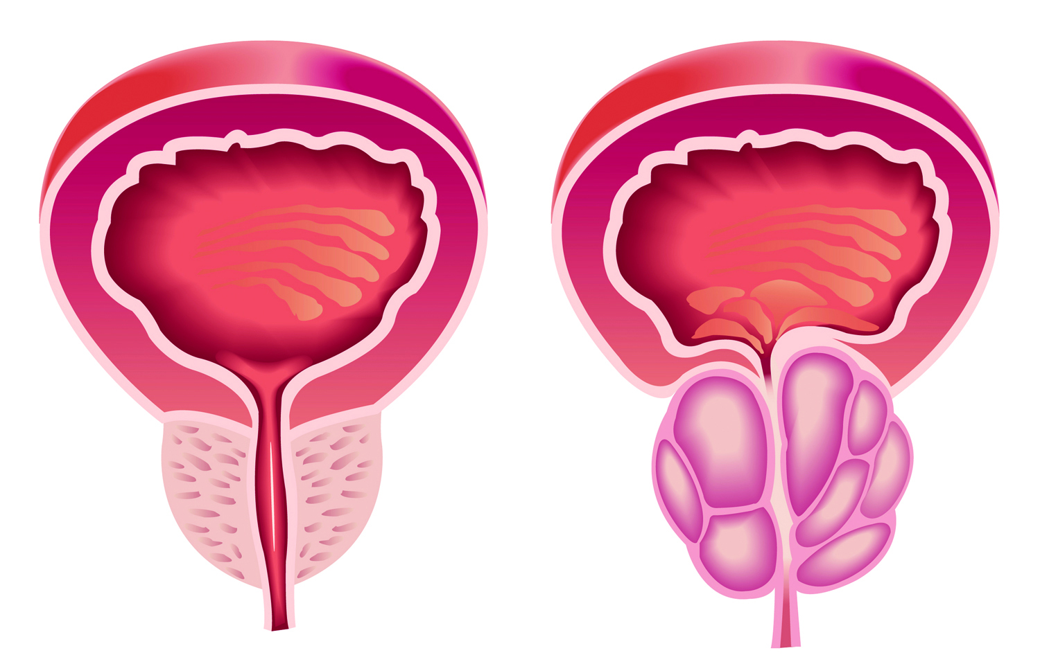 (Izquierda) Próstata Normal (Derecha) HBP