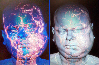 Imágenes en 3D de la malformación arteriovenosa que padecía el paciente Fuente: Hospital Vall d’Hebron