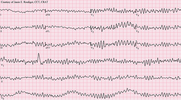 Arritmia cardiaca Autor/a dela imagen: Jer5150  Fuente: Wikipedia 