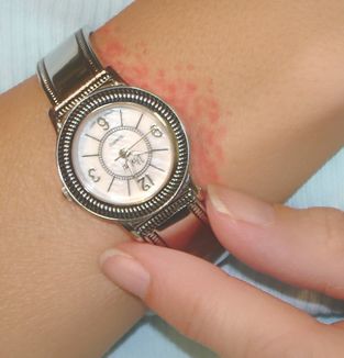 alergia-metal-reloj