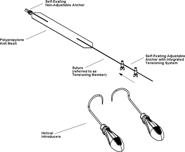 Altis single incision sling system Fuente: Dra. Madurga