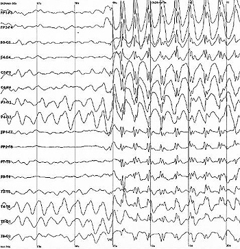 Electroencefalografía (3 Hz) de un niño en el momento de una crisis epiléptica Autor/a de la imagen:  Der Lange / German Wikipedia Fuente: Wikipedia