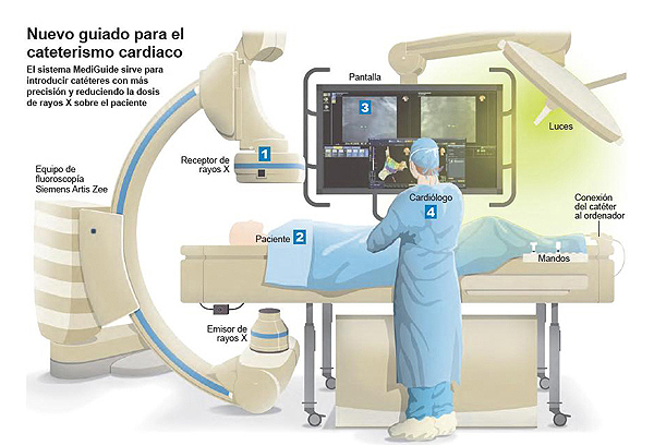 Infografía sobre el nuevo guiado para el cateterismo cardiaco Fuente: Clínica Universidad de Navarra