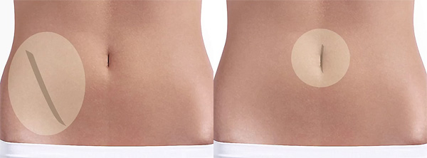 A la izquierda, cirugía abierta; a la derecha cirugía mínimamente invasiva Fuente: Fundación Puigvert