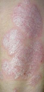 Placas de psoriasis en el codo («Psoriasis». Publicado bajo la licencia CC BY-SA 3.0 vía Wikimedia Commons) Autor/a de la imagen: User:Marnanel Fuente: Wikipedia / Methoxyroxy~commonswiki
