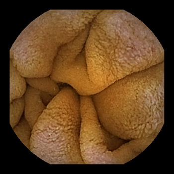 Imagen tomada por la cápsula endoscópica Fuente: SEPD 