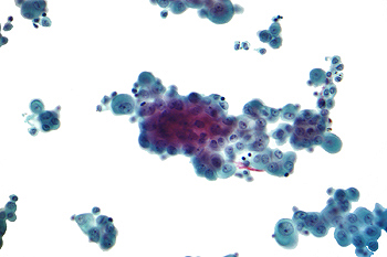 Microscopia de líquido pleural, citología en un mesotelioma Autor/a de la imagen: Nephron Fuente: Wikipedia