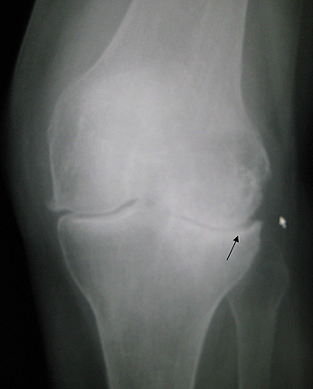Artrosis de rodilla Autor/a de la imagen: James Heilman, MD Fuente: Wikipedia