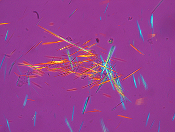 Cristales de ácido úrico del líquido sinovial de un enfermo de gota Autor/a de la imagen: Bobjgalindo  Fuente. Wikipedia