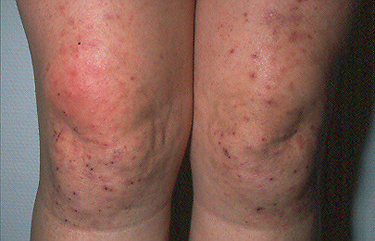 Dermatitis herpetiforme en rodillas Autor/a de la imagen: BallenaBlanca  Fuente: Wikipedia