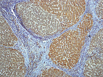 Muestra de tejido de un hígado humano con cirrosis donde se observan cambios en la estructura y una elevada expresión de la proteína CPEB4 en los nódulos de regeneración. Fuente: IRB Barcelona