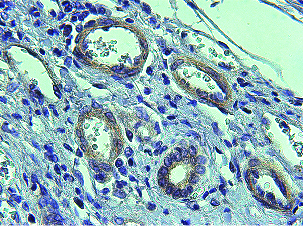Vasos patológicos (círculos blancos) en tejido cirrótico, con abundante expresión de proteína CPEB4 Fuente: IRB Barcelona 