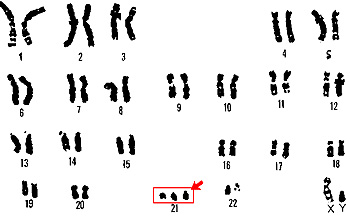 Cariotipo de la trisomía 21 (Síndrome de Down) Autor/a de la imagen: U.S. Department of Energy Human Genome Program. - http://www.ornl.gov/sci/techresources/Human_Genome/graphics/slides/elsikaryotype.shtml  Fuente: Wikipedia