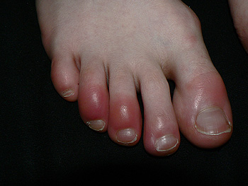 Sabañones en los dedos de los pies Autor/a de la imagen: Sapp Fuente: Wikipedia