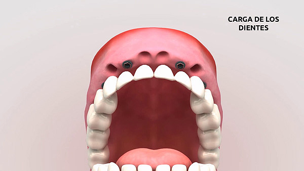 Carga de los dientes provisionales Fuente: COM SALUD