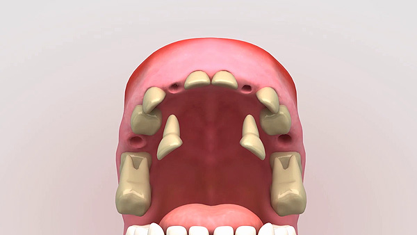 Se extraen algunas piezas dentales dañadas antes de la colocación de la primera férula Fuente: COM SALUD