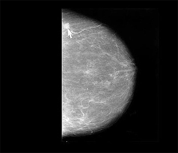 Mamografía que muestra un cáncer de mama (indicado con la flecha) NIH Senior Health Fuente: Viquipèdia / Wikipedia