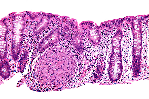 Biopsia donde se puede apreciar inflamación granulomatosa del colon en un caso de enfermedad de Crohn (tinción H-E) Autor/a de la imagen: Fuente: Nephron Fuente: Viquipèdia / Wikipedia 