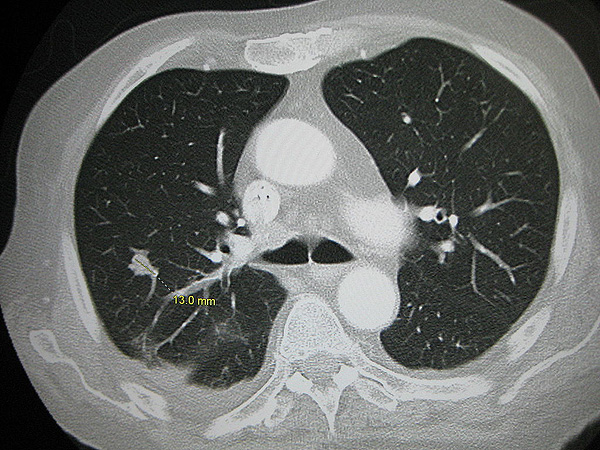 Metástasis pulmonar Autor/a de la imagen: James Heilman, MD Fuente: Wikimedia Commons