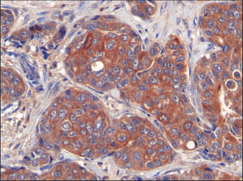 Los tumores de mama expresan altos niveles de proteína LIPG  F Slebe, IRB Barcelona Fuente: IRB Barcelona