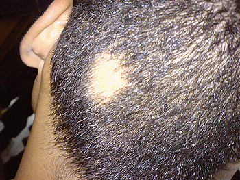 Ejemplo de alopecia areata Autor/a de la imagen: Abbassyma de Wikipedia en inglés - Transferido desde en.wikipedia a Commons. Fuente: Wikipedia