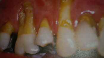 Enfermedad periodontal Autor/a de la imagen: Turca2015 Fuente: Wikipedia