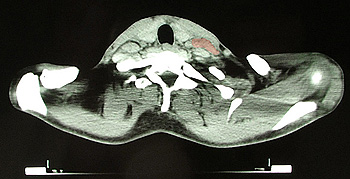 Un linfoma de Hodgkin en el que se vislumbran los ganglios linfáticos agrandados (marca roja) Autor/a de la imagen: JHeuser Fuente: Wikimedia Commons