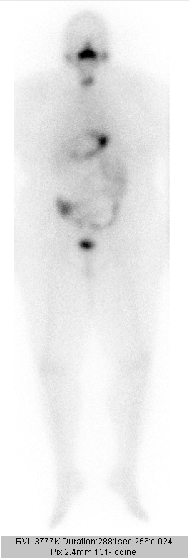 Gammagrafía de cuerpo entero en un paciente tras 3 días de terapia para el cáncer de tiroides Autor/a de la imagen: Drahreg01 [Whole-body-scan after 3rd therapy of thyroid cancer with 3.7 GBq Iodine-131] Fuente: Wikipedia