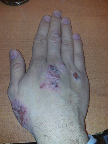 Mano con dermatitis atópica Autor/a: Tipo-Holic Fuente: Wikipedia