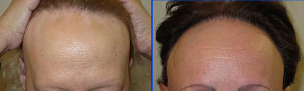 Dos casos de alopecia frontal fibrosante Fuente: Cortesía del Dr. Grimalt