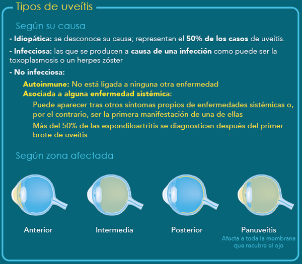 Infografía sobre los tipos de uveítis Fuente: AbbVie / Agencia Ketchum / AUVEA (Asociación de Pacientes de Uveítis)