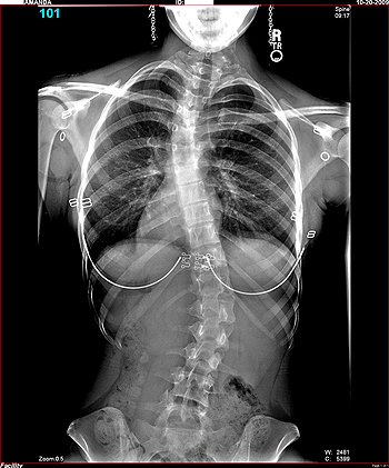Radiografía de una joven de 16 años y 8 meses con escoliosis vista de frente, de pie y con ropa (los pendientes y los aros del sostén son claramente visibles) Autor/a de la imagen: University of Utah Hospital - Radiology Department - X-Ray Image Fuente: Wikipedia