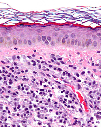 Micrografía de una mastocitosis. Biopsia de piel. Tinción hematoxilina-eosina Autor/a de la imagen: Nephron Fuente: Wikipedia