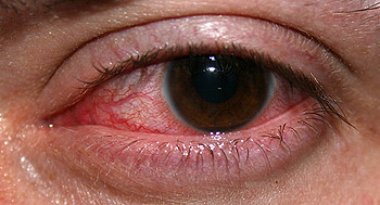 Ojo con queratitis Autor/a de la imagen: Eddie314 de en.wikipedia.org Fuente: Wikipedia