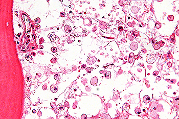 Imagen tomada con microscopio óptico de una muestra de tejido óseo afectada por la enfermedad de Gaucher.Se observa acúmulo de lípidos complejos en el citoplasma de macrófagos de la médula ósea (células de Gaucher) Autor/a de la imagen: Nephron Fuente: Wikipedia 