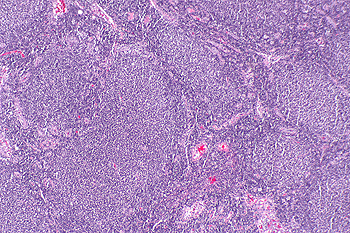 Microfotografía de linfoma folicular, que muestra los característicos folículos linfoides que le dan el nombre a la enfermedad. Tinción H&E Autor/a de la imagen: Nephron  Fuente: Wikipedia  