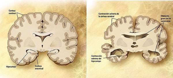 Comparación entre un cerebro normal y un cerebro afectado de Alzheimer. Esquema de un corte frontal de dos cerebros. El de la izquierda es un cerebro sano y el de la derecha uno que padece dicha enfermedad neurológica Autor/a de la imagen: COMPARISONSLICE_HIGH.JPG: *derivative work: Garrondo (talk) SEVERESLICE_HIGH.JPG: ADEAR: "Alzheimer's Disease Education and Referral Center, a service of the National Institute on Aging." PRECLINICALSLICE_HIGH.JPG: ADEAR: "Alzheimer's Disease Education and Referral Center, a service of the National Institute on Aging." - COMPARISONSLICE_HIGH.JPG Fuente: Wikipedia