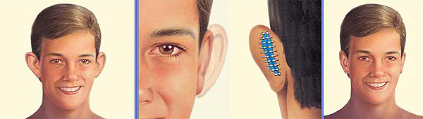 Diferentes pasos de una otoplastia. A la izquierda, orejas de ‘soplillo’; en el centro, la intervención, y a la derecha los pabellones auditivos ya corregidos Fuente: Gentileza de SECPRE