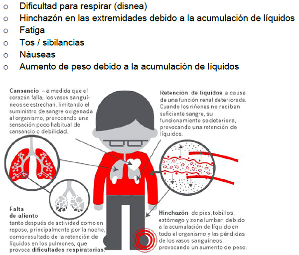 Infografía sobre los síntomas de la insuficiencia cardiaca Fuente: Novartis