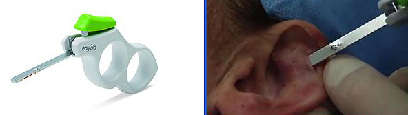 Imagen de la izquierda: el introductor o aparato que se utiliza para colocar el implante en la oreja Fuente: Allergan / Agencia Ketchum  Imagen de la derecha: momento en el que el introductor coloca el implante en la oreja de una paciente Fuente: ‘Alessandro Gualdi e l'Earfold. Correzione mini invasiva delle "orecchie a sventola"’ (Youtube)