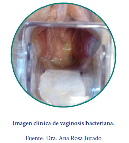 Imagen clínica de vaginosis bacteriana
