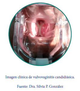 Imagen clínica de vulvovaginitis candidiásica
