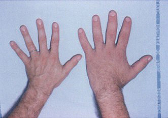 Mano de una persona no afectada (izquierda), y mano de un paciente con acromegalia (a la derecha) Autor/a de la imagen: Philippe Chanson and Sylvie Salenave -Acromegaly. Orphanet Journal of Rare Diseases 2008, 3:17. doi:10.1186/1750-1172-3-17 Fuente: Wikimedia Commons