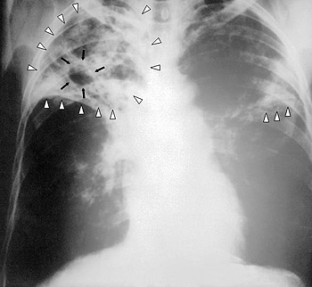 Una placa anteriorposterior de rayos X de un paciente diagnosticado con una avanzada tuberculosis en ambos pulmones. Esta radiografia del pecho revela la presencia de una infiltración (triángulos blancos) y una cavidad (flechas negras) presentes en el lado derecho. El diagnóstico es Tuberculosis en un grado severo de avance